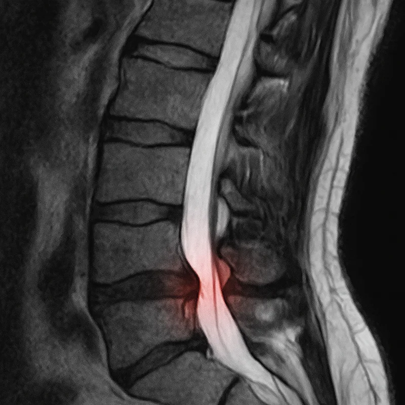 X-ray image of herniated disc