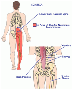 Sciatica can travel from the low back, down the thigh, to beyond the knee and into the feet.