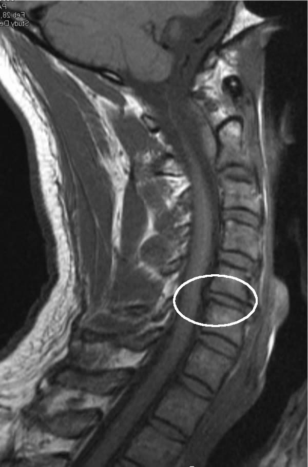 Cervical Disc Herniation Relief with Chiropractic - Hometown Family Wellness Center