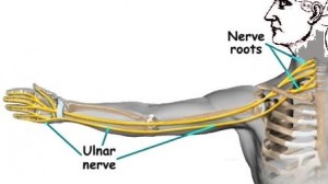 Ulnar Nerve Entrapment can occur at the neck, shoulder, elbow or wrist.