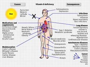 Vitamin D Deficiency can cause chronic pain as well as other conditions
