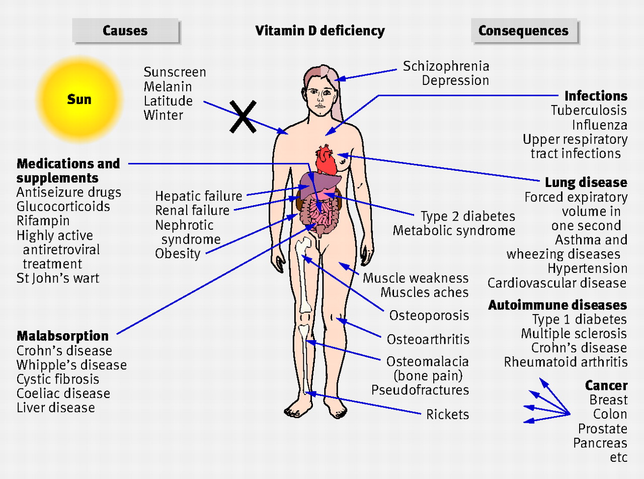 Vitamin D Deficiency A Cause Of Chronic Pain Hometown