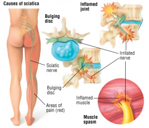 Medications are ineffective at removing the cause of sciatica pain