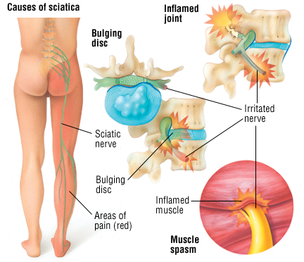 https://www.chiropractorfreehold.com/wp-content/uploads/2015/01/Causes-of-Sciatica.jpg