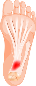 If you experience foot pain you might have plantar fasciitis