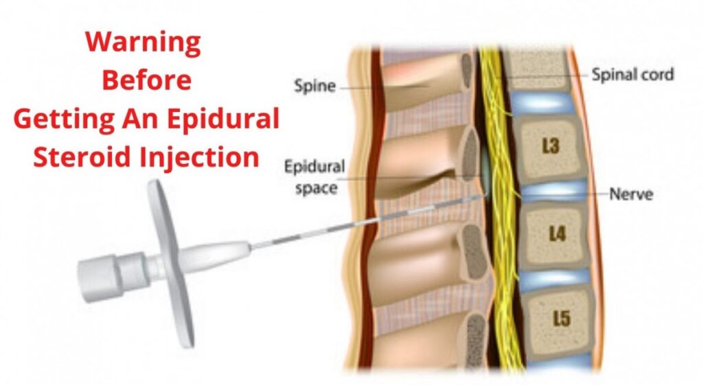 Epidural Steroid Injection Risks You Should Know Before Ever Getting