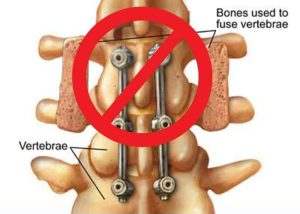 Warning about spinal surgery