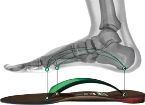 Foot over custom orthotics showcasing the precision points