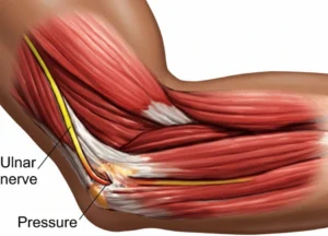 Ulnar nerve entrapment visualized in arm